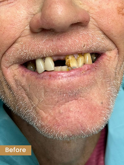 Before treatment